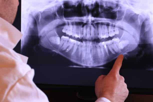 Best Emergency Wisdom Teeth Removal in Pierre Part, LA