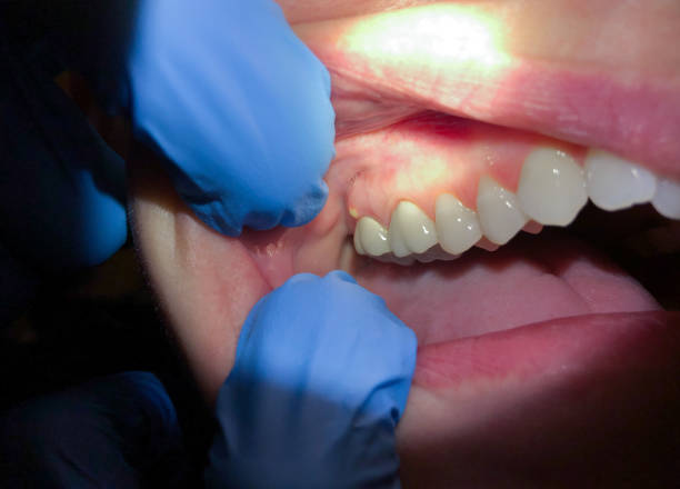 Best Emergency Dental Care for Broken or Chipped Teeth in Pierre Part, LA