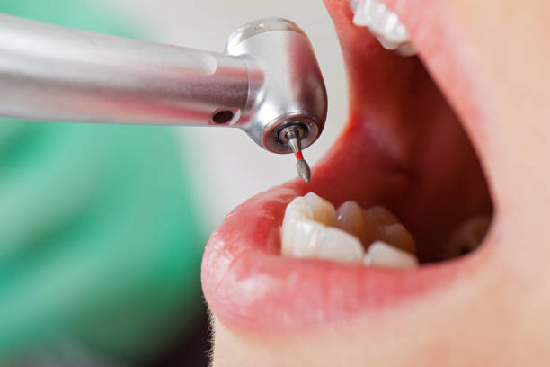 Best Emergency Tooth Extraction in Pierre Part, LA
